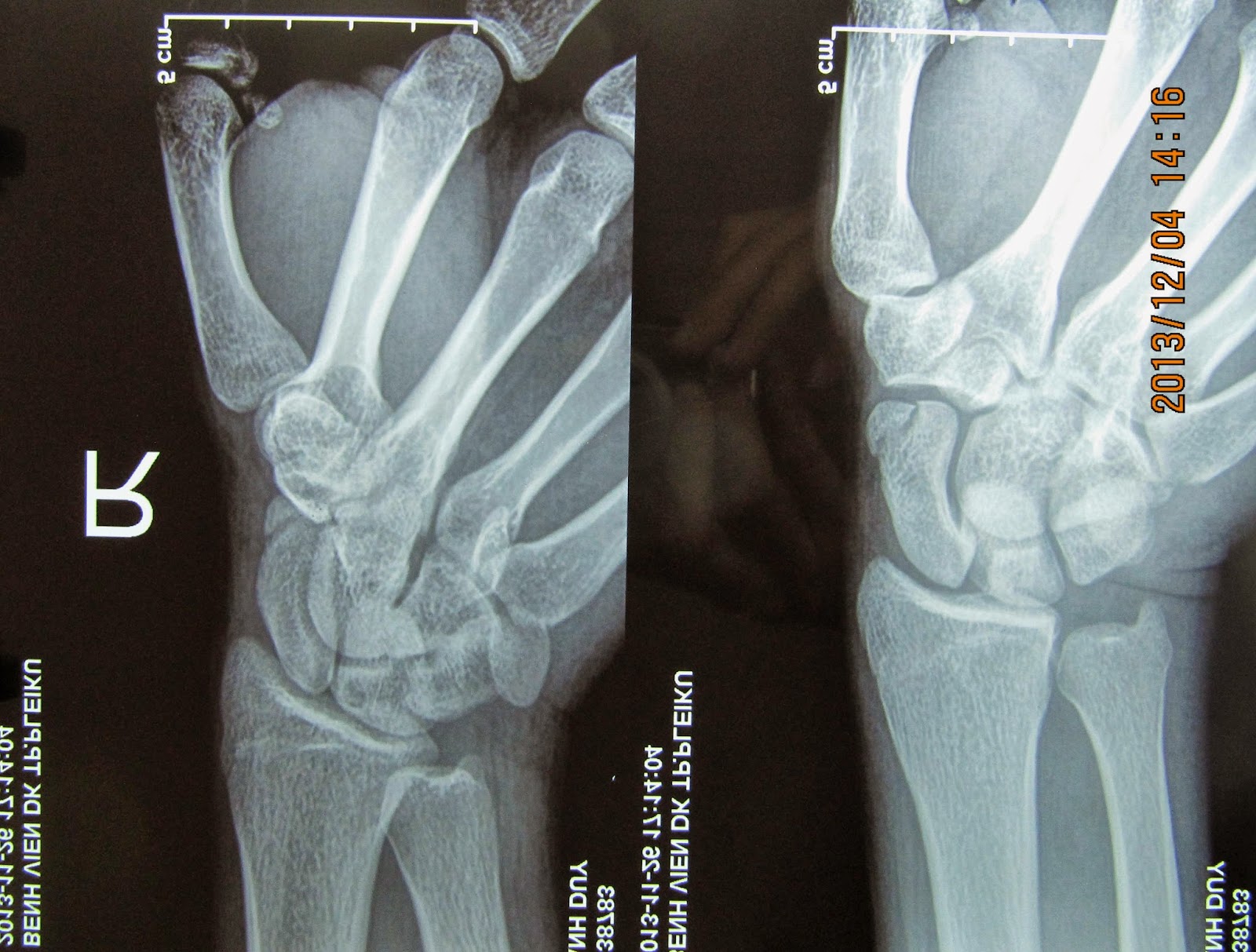 Gãy xương thuyền - Hình ảnh minh họa